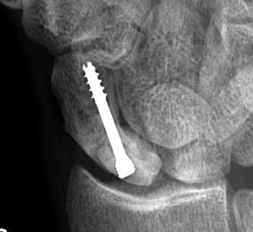 Scaphoid Proximal Pole ORIF AVN